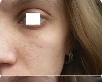 Eye patches: types, how to use What to put under the eyes